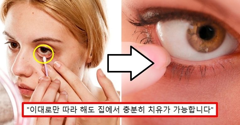 “혹시 나도 안구건조증?” 눈 기름샘 청소로 안구건조증 없애는 방법